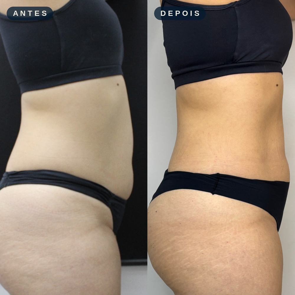 Antes e depois - Ultrassom Macrofocado