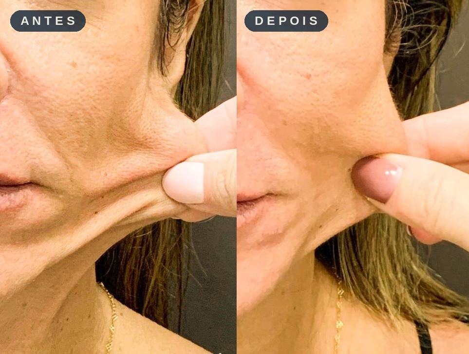 Antes e depois - Bioestimulador de Colágeno