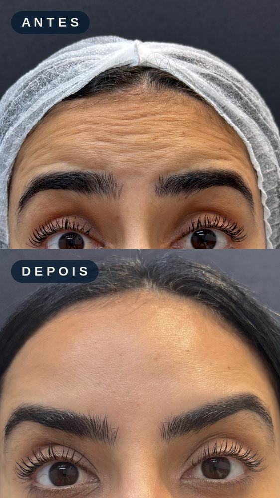Antes e depois - Toxina Botulínica