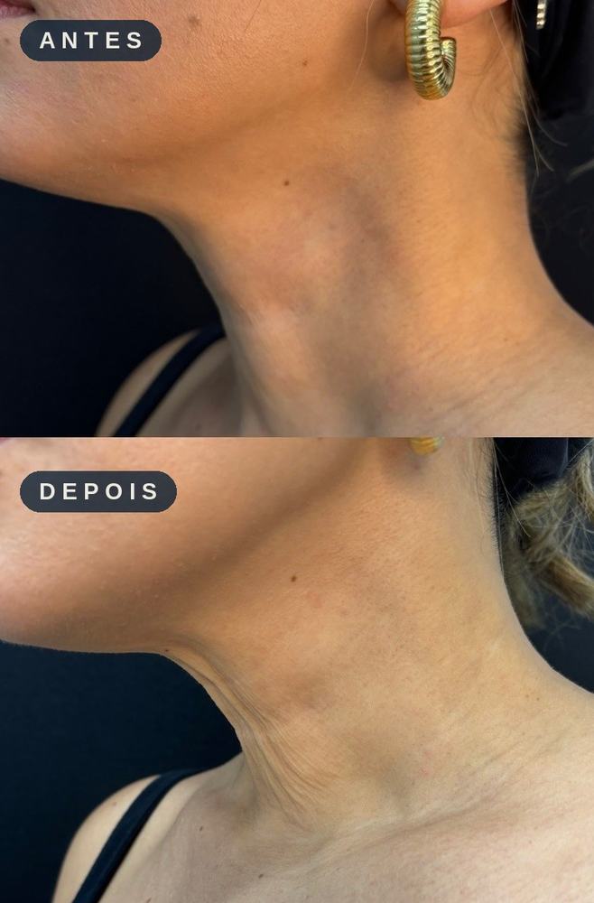 Antes e depois - Ultrassom Microfocado
