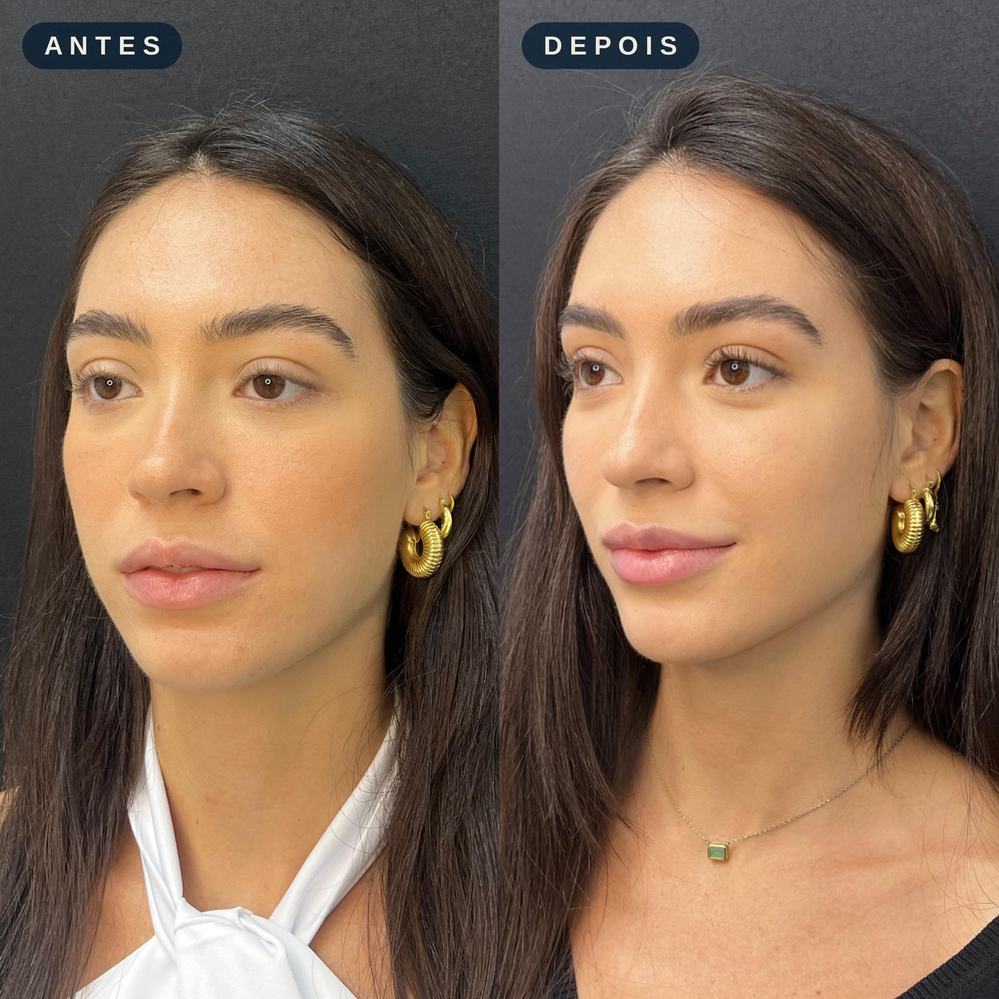 Antes e depois - Preenchimento Facial